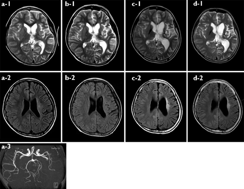 Atypical basal ganglia germinoma presenting as cerebral hemiatrophy