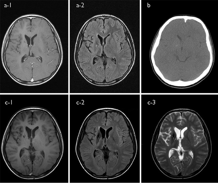 Atypical basal ganglia germinoma presenting as cerebral hemiatrophy