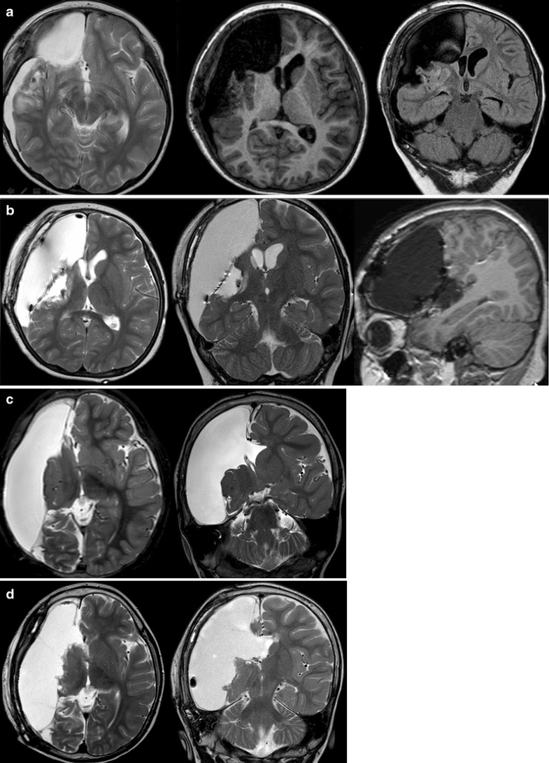 Insular epilepsy surgery under neuronavigation guidance using depth