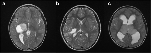 Pediatric thalamic tumors in the MRI era: a Canadian perspective ...