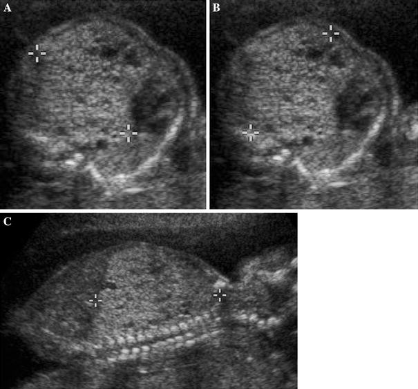 Congenital cystic lung disease: contemporary antenatal and ...