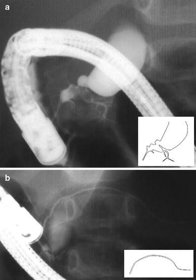 Pancreas divisum in pancreaticobiliary maljunction in children