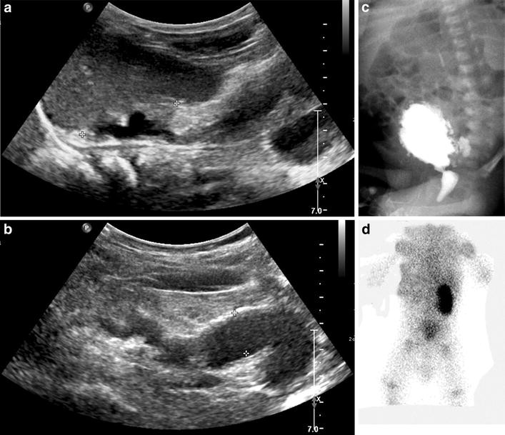 Posterior urethral valves longterm SpringerLink