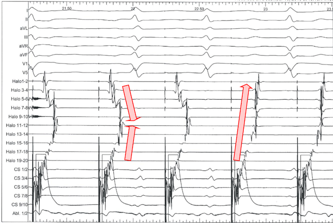 Typisches Vorhofflattern | SpringerLink