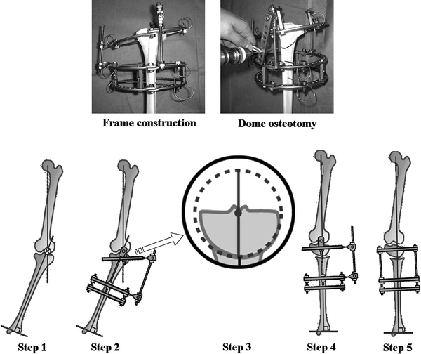 Acute Correction Using Focal Dome Osteotomy For Deformity About Knee