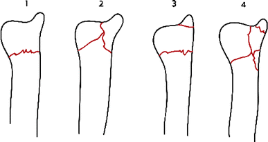 fig fracture distal radius orif
