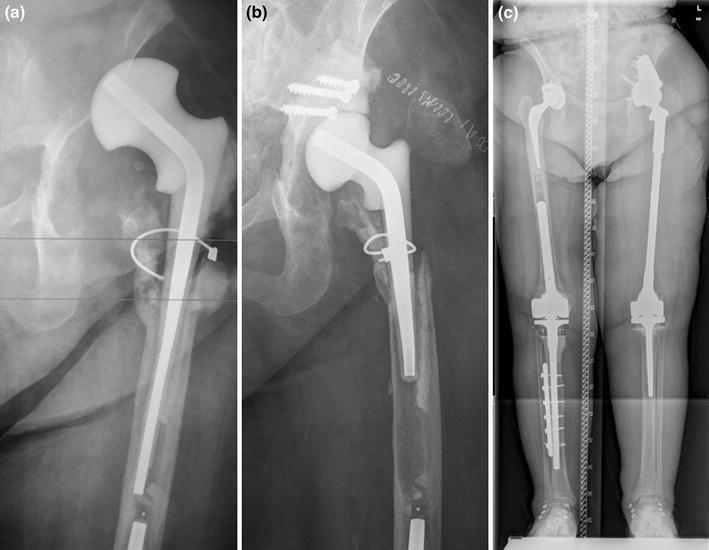 Temporary cement tectoplasty a technique to improve prefabricated hip