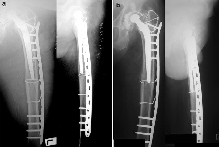 Percutaneous Cerclage Wiring And Minimally Invasive Plate