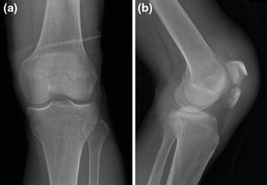 Locked Tension Band Wiring Using Ring Pins For Patellar Fractures: A 