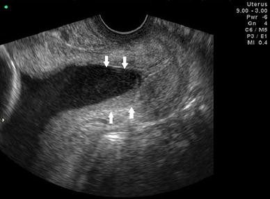 Short Cervix Syndrome: Current Knowledge From Etiology To The Control 