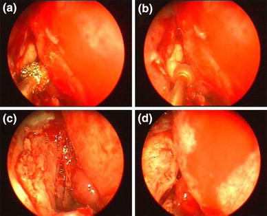 endoscopic dcr stents