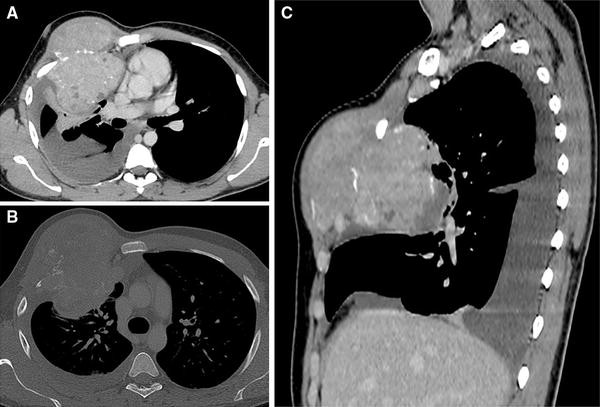 A Giant Cell Tumor Arising from the Anterior Costal Arc in a Young Man ...