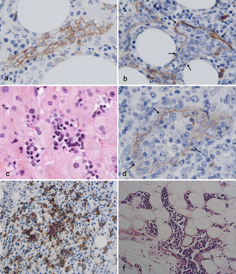 Primary Splenic Diffuse Large B-cell Lymphoma Manifesting In Red Pulp ...