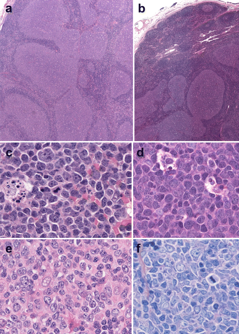 Indolent Lymphomas In The Pediatric Population: Follicular Lymphoma ...