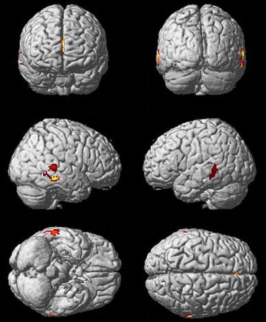 In Autism Brain Shows Unusual Thinning >> Changes In Grey Matter Development In Autism Spectrum Disorder In Autism Brain Shows Unusual Thinning >> Changes In Grey Matter Development In Autism Spectrum Disorder