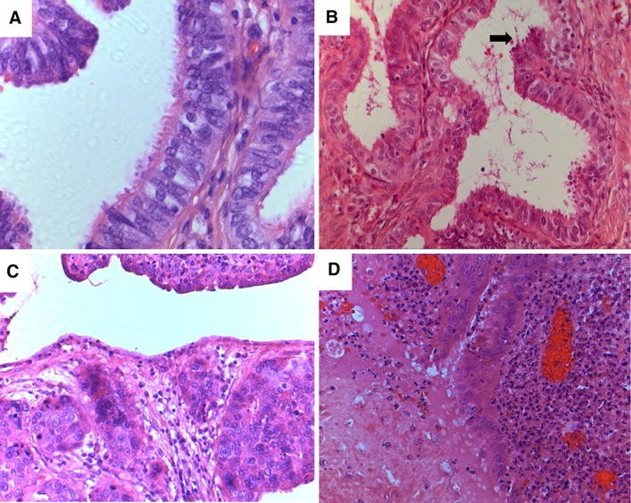 Prophylactic bilateral salpingectomy (PBS) to reduce ovarian cancer ...