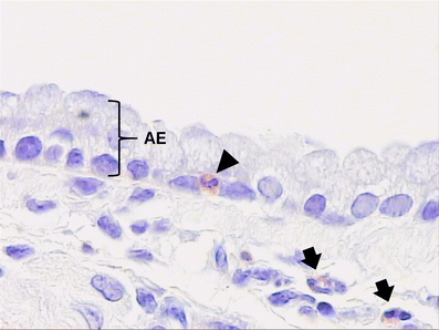 Airway Remodeling In Asthma What Really Matters Springerlink - 