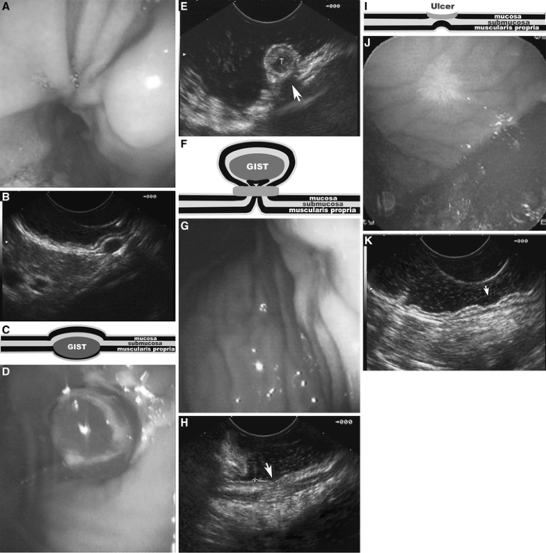 Endoscopic band ligation of small gastric stromal tumors and followup
