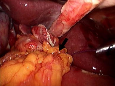 simple suture with omental patch