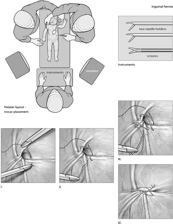 herniorrhaphy