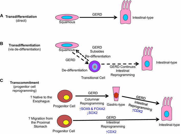 Reflux Esophagitis And Its Role In The Pathogenesis Of Barrett S reflux esophagitis and its role in the