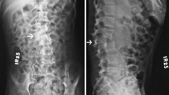 L5-s1 spondylolisthesis symptoms picture