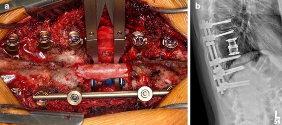 spinal fluid leak during back surgery
