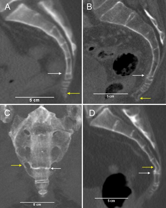 CT morphology and morphometry of the normal adult coccyx | SpringerLink