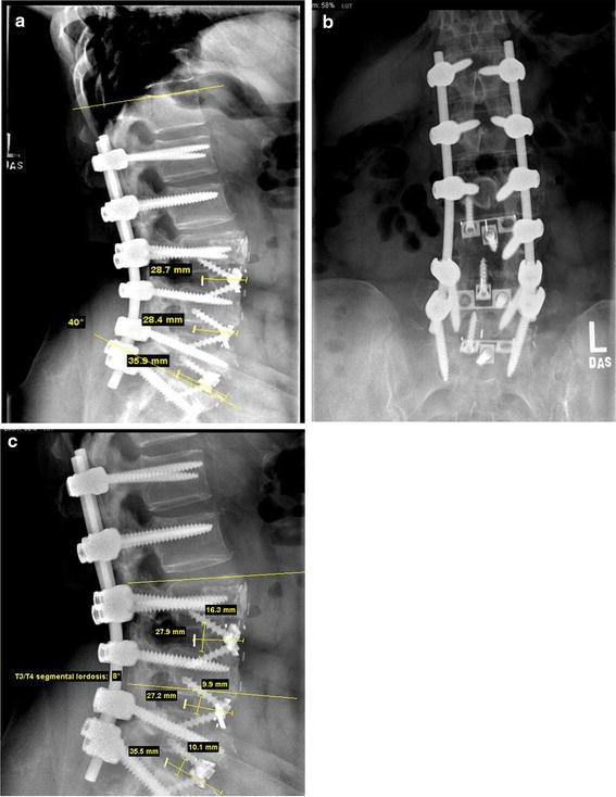 Radiological evaluation of anterior lumbar fusion using PEEK cages with