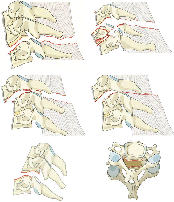 AOSpine subaxial cervical spine injury classification system | SpringerLink