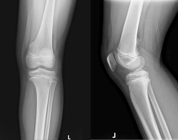 Distal Femoral Cortical Proliferative Irregularity With Excavation