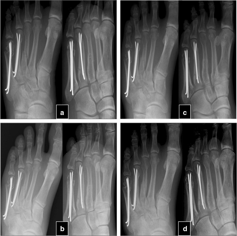 Patient with tibia nonunion. a X-ray from the pre-treatment period