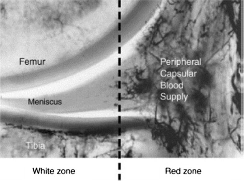 Current Concepts In The Techniques Indications And Outcomes Of Meniscal Repairs Sogacot