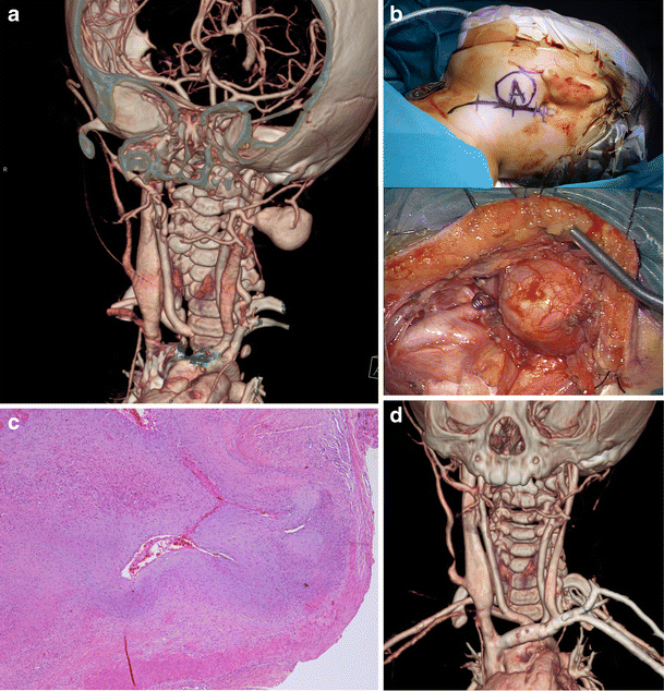 A giant fusiform aneurysm of the external carotid artery branch in an ...