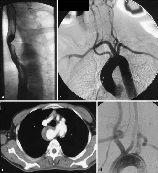 Extrathorakal zervikalendovaskuläre Hybridoperationen zur Behandlung