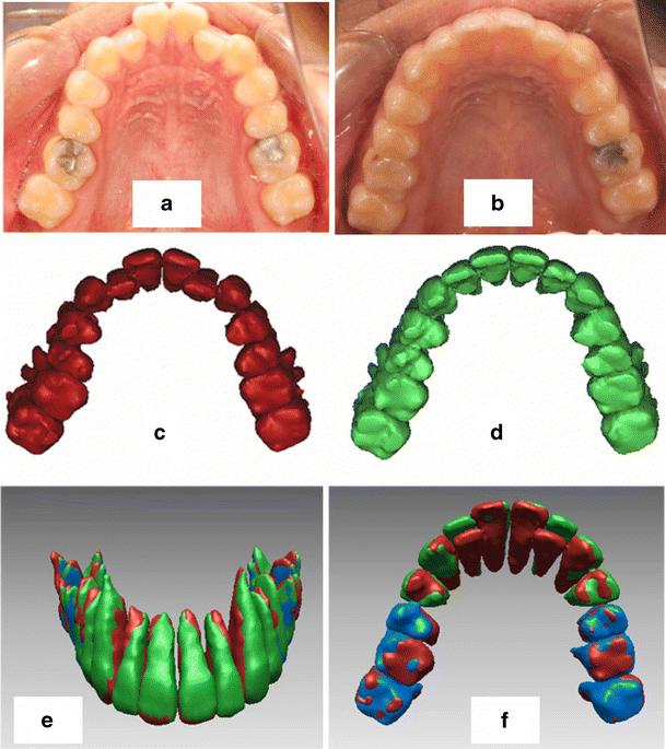 Bone density changes around teeth during orthodontic treatment