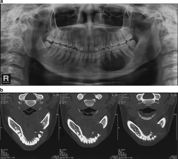The approach of ameloblastoma of the mandible a case treated by