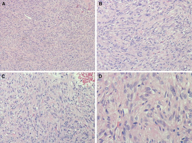 Spindle cell oncocytoma of the adenohypophysis SpringerLink