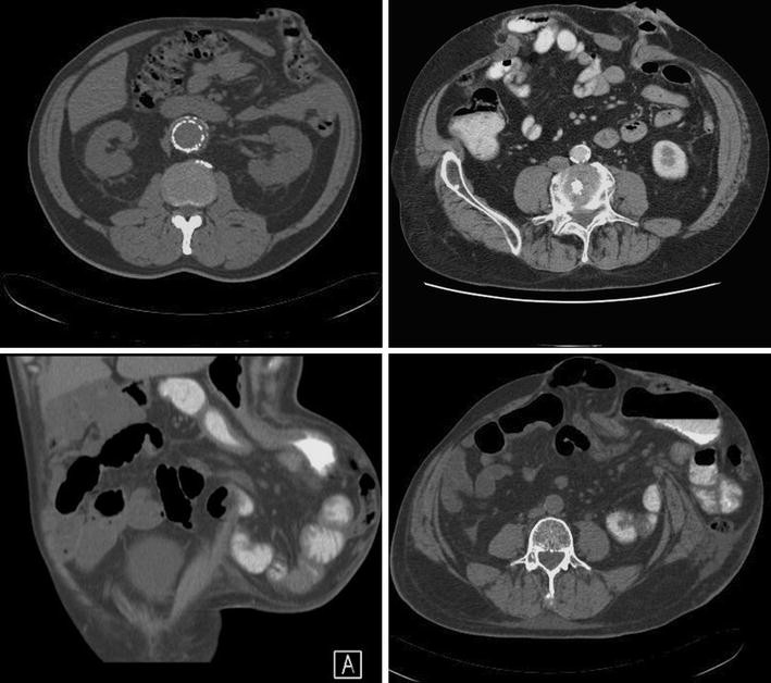 European Hernia Society classification of parastomal hernias SpringerLink