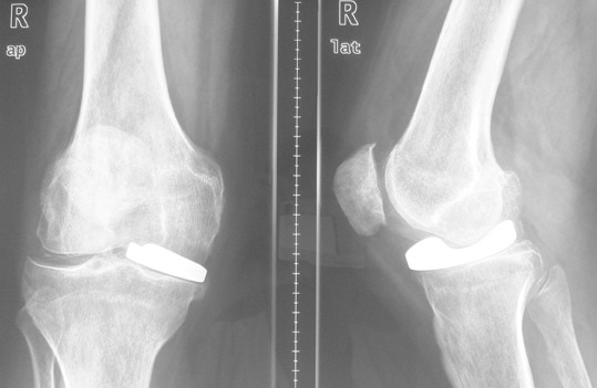 Minimalinvasiver Unikompartimenteller Kniegelenkersatz - 
