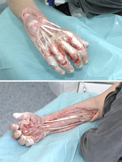 Nekrotisierende Fasziitis der oberen Extremität | SpringerLink