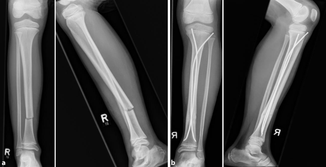 Unterschenkelschaftfrakturen | SpringerLink