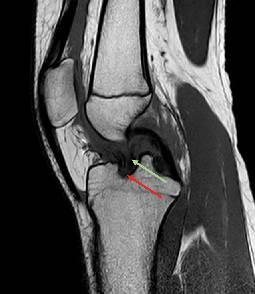 Operative und konservative Therapie der vorderen Kreuzbandruptur im