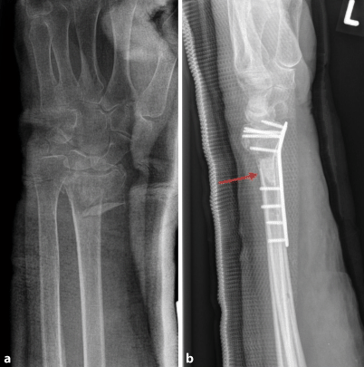 Nanostrukturiertes synthetisches Knochenersatzmaterial zur Behandlung