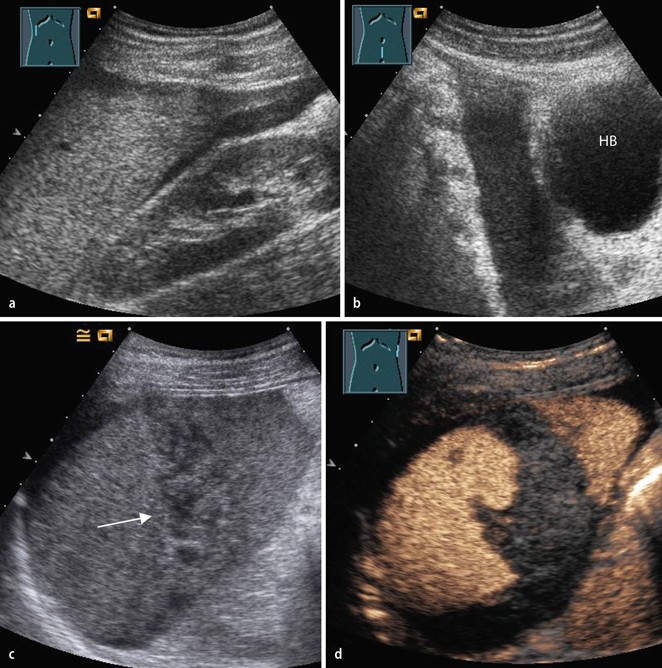 Abdomineller Ultraschall SpringerLink