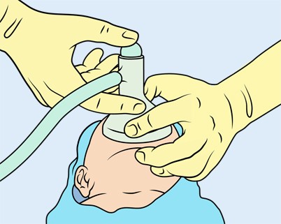 Die Versorgung und Reanimation des Neugeborenen | SpringerLink