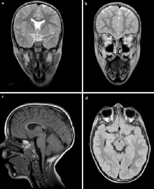 Septo Optic Dysplasia Plus And Dyskinetic Cerebral Palsy In