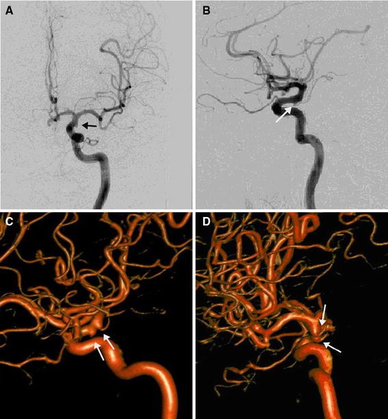 High Riding Innomate Artery Differential diagnosis of infundibular dilation versus a small aneurysm ...