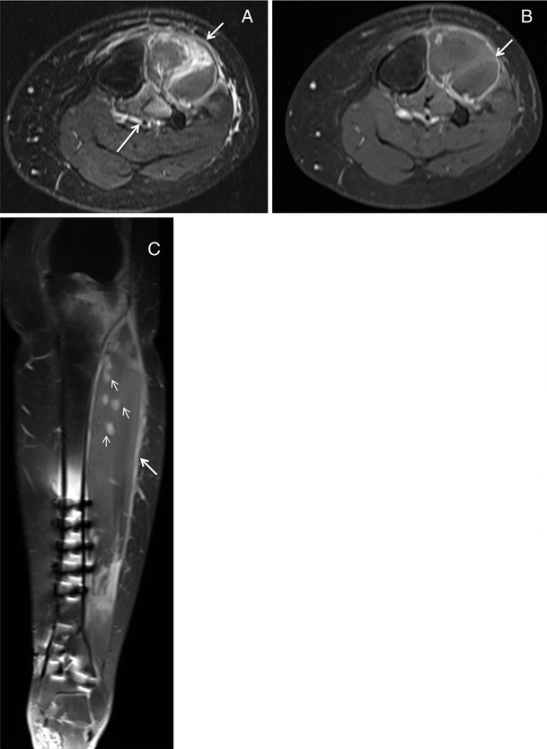 compartments of leg radiology compartments of leg radiology
