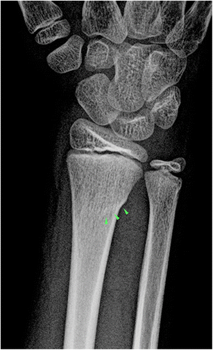 buckle fracture wrist healing time buckle fracture wrist healing time